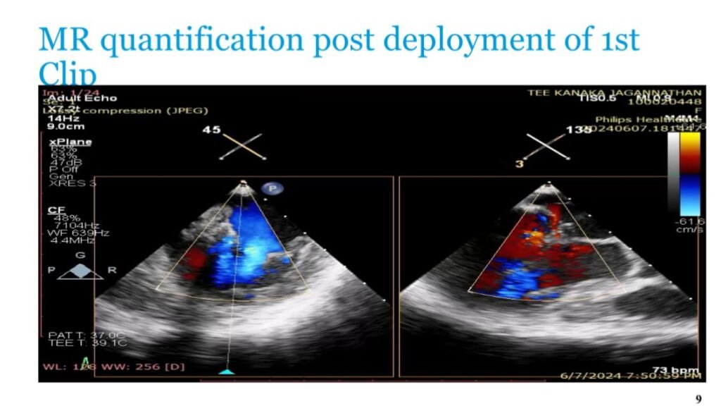 MR Quantification post deployment of 1st clip
