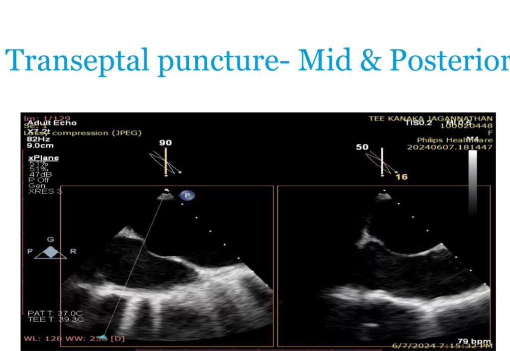 Transeptal Puncture- Mid Posterior